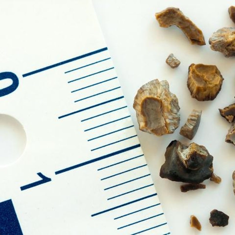 سنگ کلیه 4 و 5 میلی متری